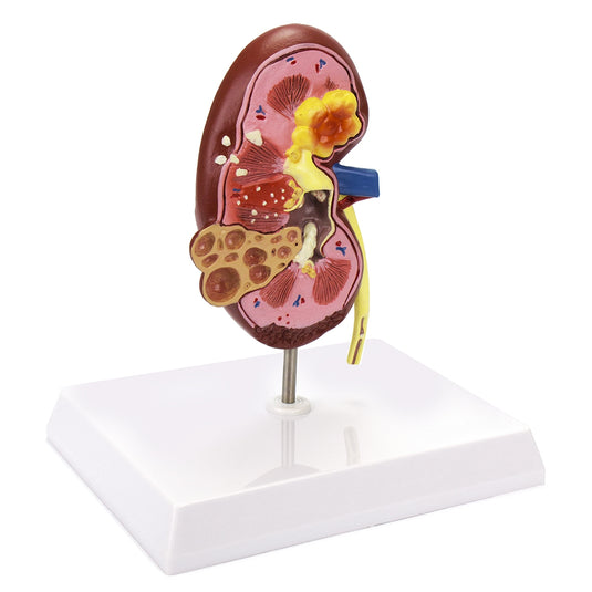 Mô hình thận có bệnh lý, phóng đại 2,5X [SKU: MG31019]