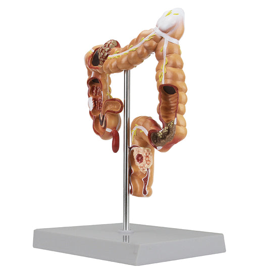 Mô hình bệnh lý ruột kết và trực tràng [SKU: MG35589]